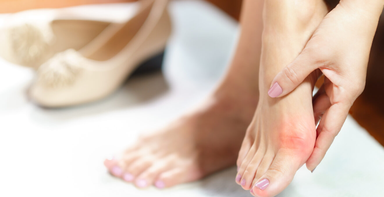 hallux valgus